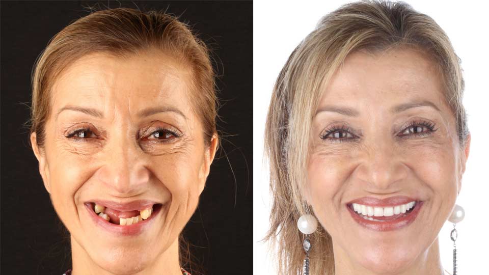 Ask an Expert: Top 11 Dental Implant FAQ's Answered