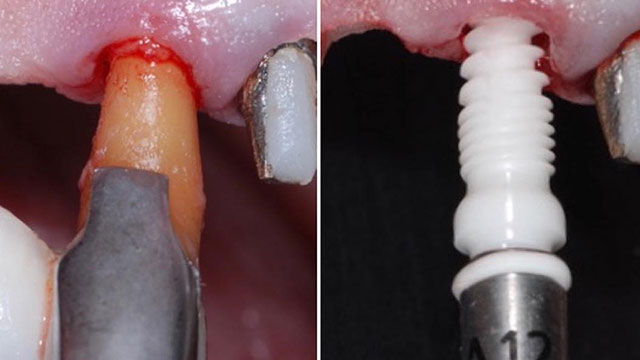 The Changing Science of Implant Dentistry